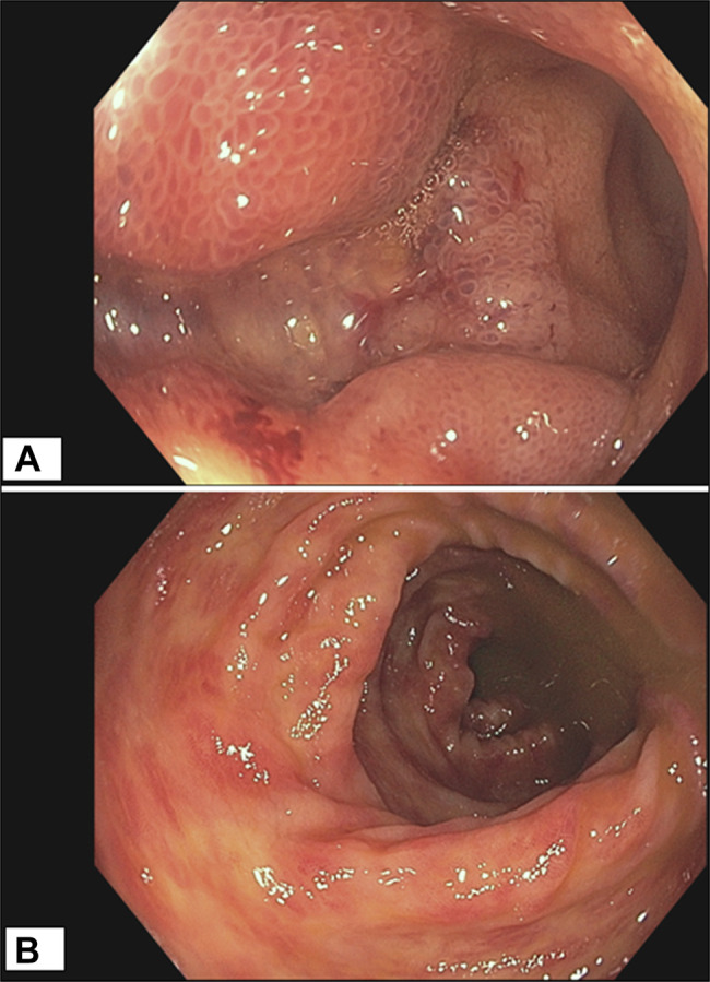 New Diagnosis of Granulomatosis With Polyangiitis Presenting With Oral Ulcerations, Ileitis, and Hematochezia.
