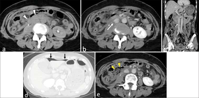 Blunt traumatic inferior vena cava injury associated with seatbelt syndrome: The critical role of diagnosis and non-operative management.