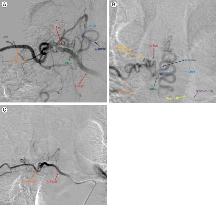 Successful treatment of rapid onset Foix-Alajouanine syndrome following hyperselective endovascular embolization of thoracic dural arteriovenous fistula: Case report, technical note and literature review.