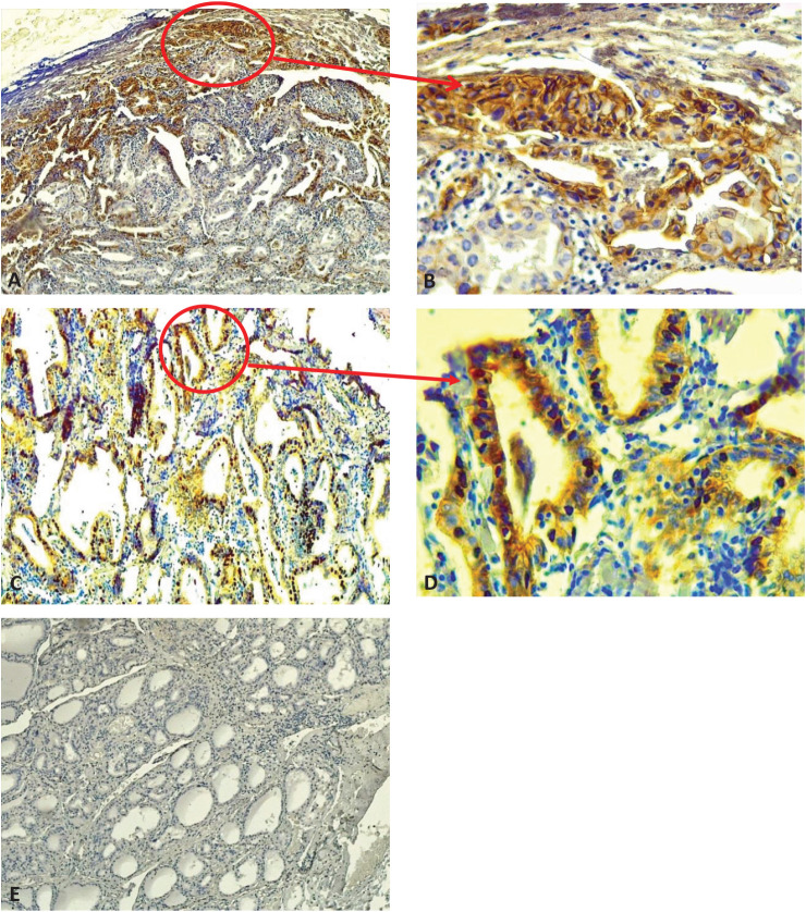 Role of epithelial-mesenchymal markers in predicting metastasis of papillary thyroid carcinoma: A retrospective case-control study.