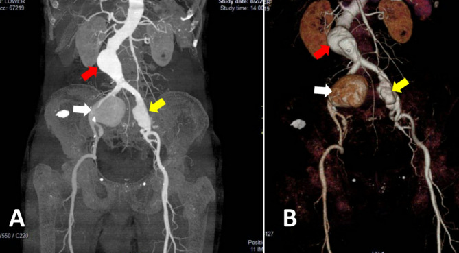 Unusual onset and presentation of isolated Uni-iliac aneurysm dissection in presence of aortoiliac aneurysms.
