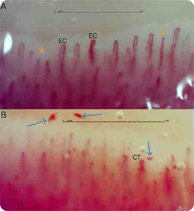 Isolated Navicular Algodystrophy and Abnormal Capillaroscopic Pattern in a 50-year-old Smoker: A Possible Microvascular Connection.