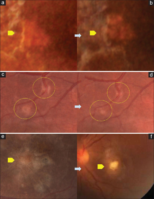 Clinical characteristics, imaging features, and fate of punctate outer retinal toxoplasmosis lesions in immunocompetent cases of ocular toxoplasmosis.