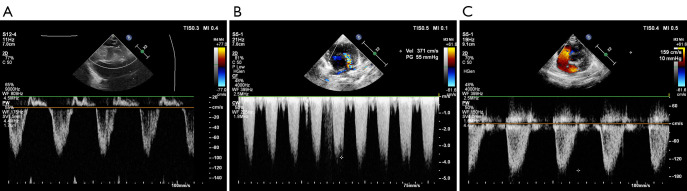 Repair of tetralogy of Fallot in neonates: a single-center case series.