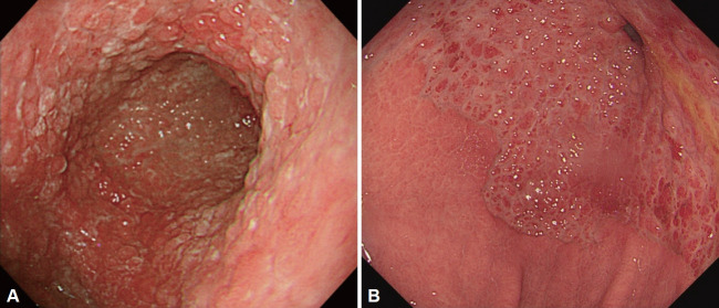 Chronic Eosinophilic Gastritis Presenting as Gastric Outlet Obstruction in a Young Man: A Case Report.