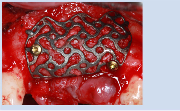 Risk factors for dehiscence in alveolar ridge augmentation using patient-specific titanium mesh: a retrospective analysis.
