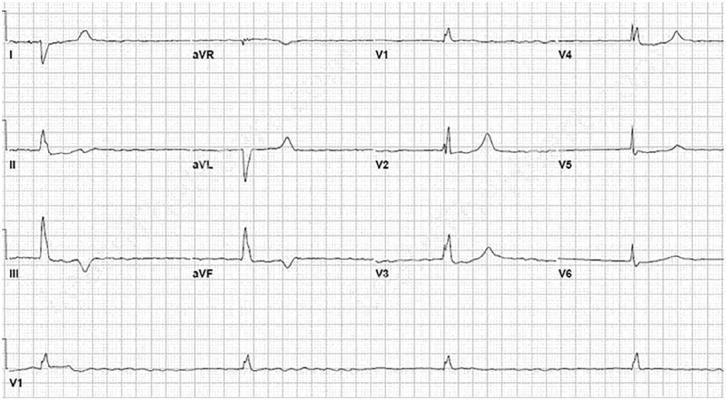 Atrial fibrillation with slow-ventricular response (AF-SVR): A literature review.