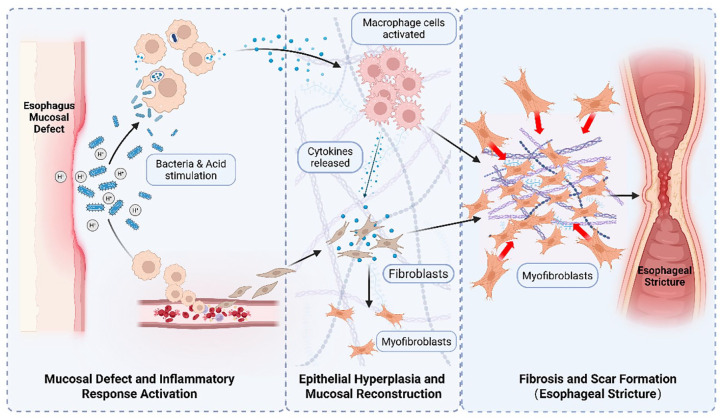 Hydrogels for preventing post-endoscopic submucosal dissection stenosis in early esophageal cancer: a comprehensive literature review.