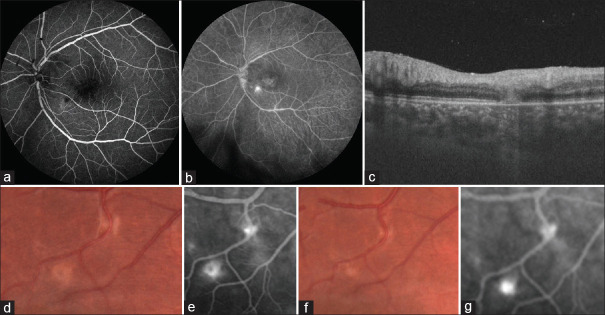 Clinical characteristics, imaging features, and fate of punctate outer retinal toxoplasmosis lesions in immunocompetent cases of ocular toxoplasmosis.