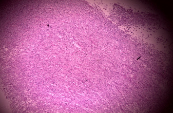 Clear Cell Carcinoma: A Rare Variant of Cholangiocarcinoma Case Report and Systematic Review.
