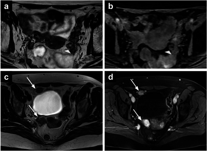 Incidental findings in female pelvis MRI performed for gynaecological malignancies.