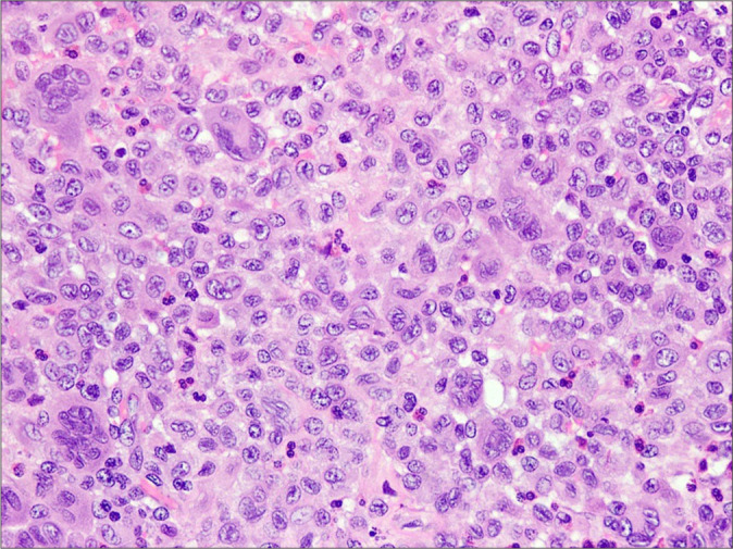 Pulmonary Langerhans cell histiocytosis: A case series and literature review.