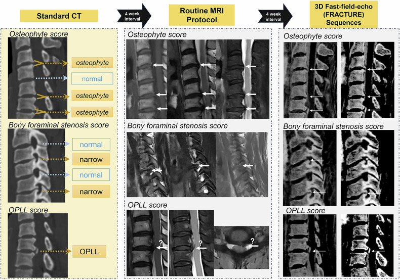 Added value of 3D fast-field-echo (FRACTURE) sequences for cervical spondylosis diagnosis: a prospective multi-reader non-inferiority study.