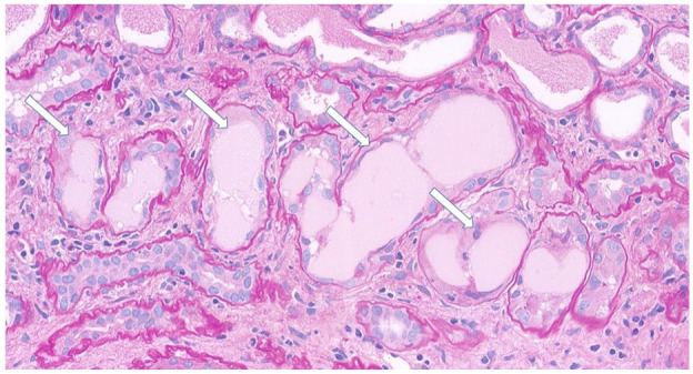 Extranodal Marginal Zone Lymphoma Presenting as Acute Kidney Injury due to Cast Nephropathy: A Case Report.