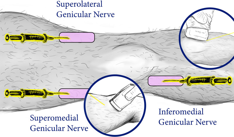 Genicular Nerve Ultrasound-Guided Cryoanalgesia for the Treatment of Chronic Knee Joint Pain: An Observational Retrospective Study.