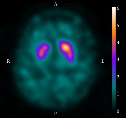 Hemichorea Associated With Nigrostriatal Dysfunction: Case Report of a Patient With an Ipsilateral Infarct in the Lenticular Nucleus and Internal Capsule.