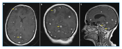 Intracranial Tuberculomas Associated with Tuberculous Meningitis.