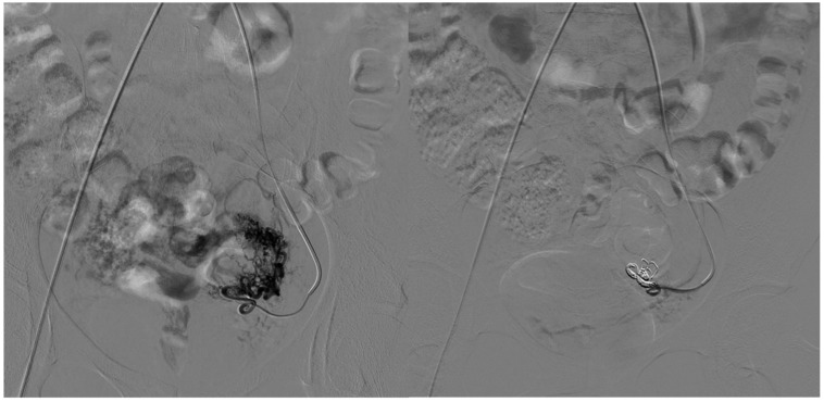 Endovascular Treatment of Extracranial Arteriovenous Malformations: A Retrospective Monocentric Case-Series Study.