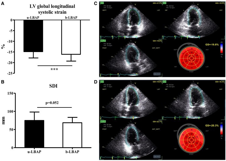 Enhanced ventricular synchrony and myocardial function with bipolar left bundle area pacing: a comparative study of anodal ring capture versus unipolar pacing.