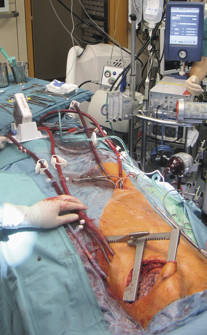 [Extracorporeal Life Support in Lung Transplantation and Beyond].