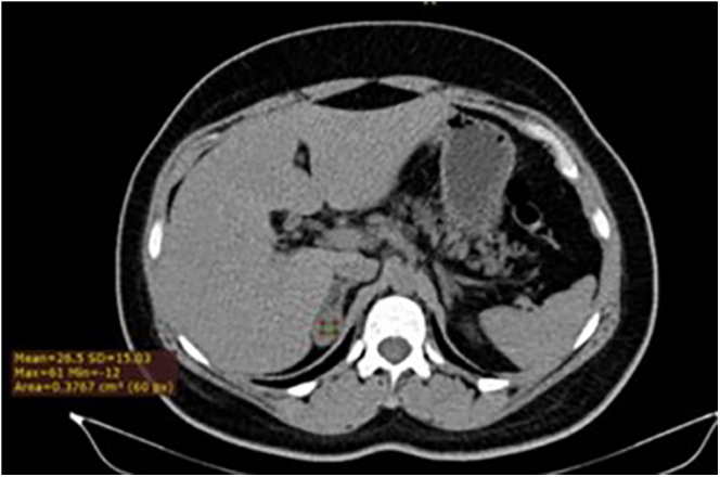 Double mutation for multiple endocrine neoplasia associated with congenital adrenal hyperplasia.