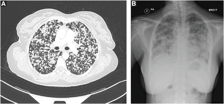 Endocrine manifestations of lung adenocarcinoma with epidermal growth factor receptor mutation mimicking tuberculosis: A case report and literature review.