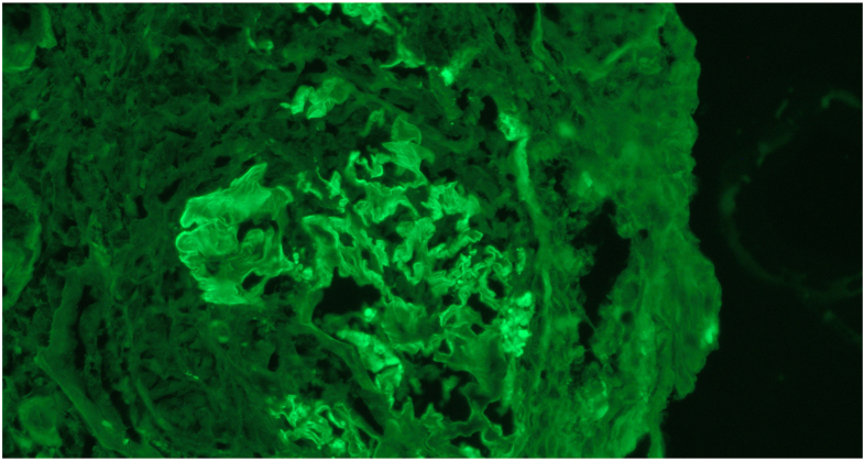 Acute Kidney Failure in Limited Scleroderma Reveals Anti-GBM--Associated Kidney Disease