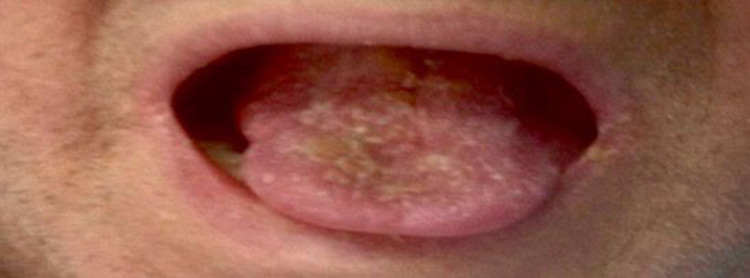 Treatment and Survival Outcomes in Rhino-Orbital Mucormycosis with and without Orbital Exenteration: A Retrospective Case Series and Literature Review.