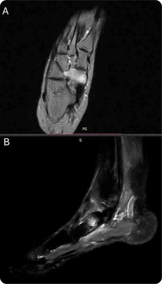 Isolated Navicular Algodystrophy and Abnormal Capillaroscopic Pattern in a 50-year-old Smoker: A Possible Microvascular Connection.