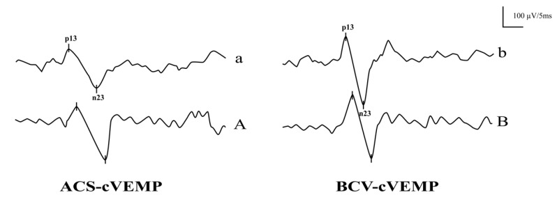 Feasibility of Early Vestibular Screening and Developmental Changes in Air- and Bone-Conducted Cervical Vestibular Evoked Myogenic Potentials in Infants and Children with Normal Hearing.