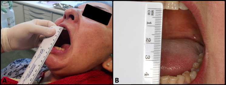 Importance of early arthrocentesis in temporomandibular joint closed lock by disc displacement without reduction. A case review.