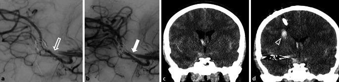 Role and Safety of Tirofiban in Peri-Interventional Antiplatelet Management for Aneurysm Treatment.