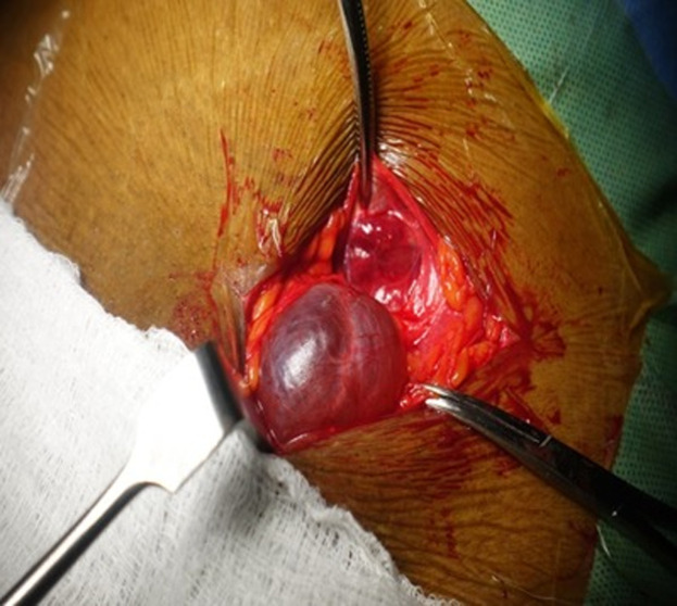 Hydrocele of the canal of Nuck mimicking an inguinal hernia in a 34-year-old pregnant woman: a case report.