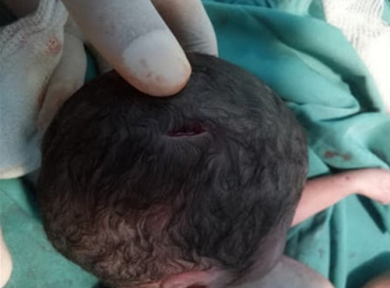 Fetal demise due to stab wound with umbilical cord transection: a case report.