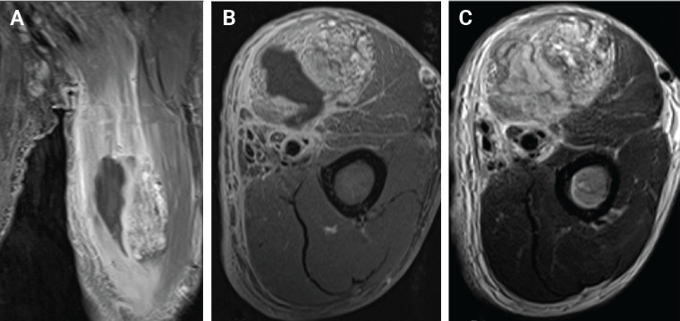 A rare case of pyomyositis with intramuscular hemangioma in the upper arm.
