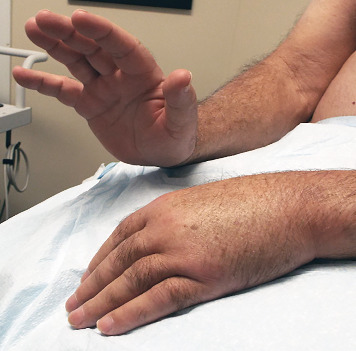 Radial Nerve Palsy as an Iatrogenic Complication of Shoulder Replacement Surgery With Significant Bone Loss of the Humerus Resembling Gorham-Stout Disease: Case Report and Review of the Literature.