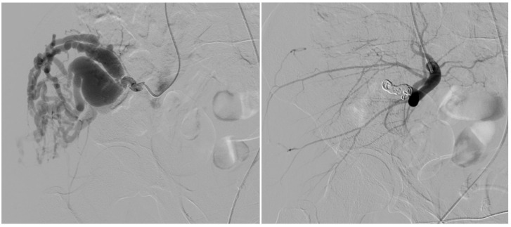 Endovascular Treatment of Extracranial Arteriovenous Malformations: A Retrospective Monocentric Case-Series Study.