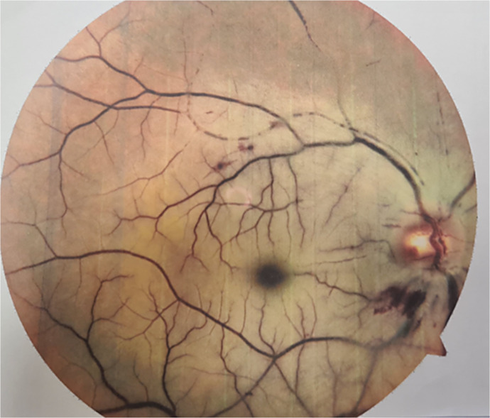 Double Jeopardy: Uncommon Concurrent Traumatic Optic Neuropathy and Central Retinal Artery Occlusion - A Case Report.