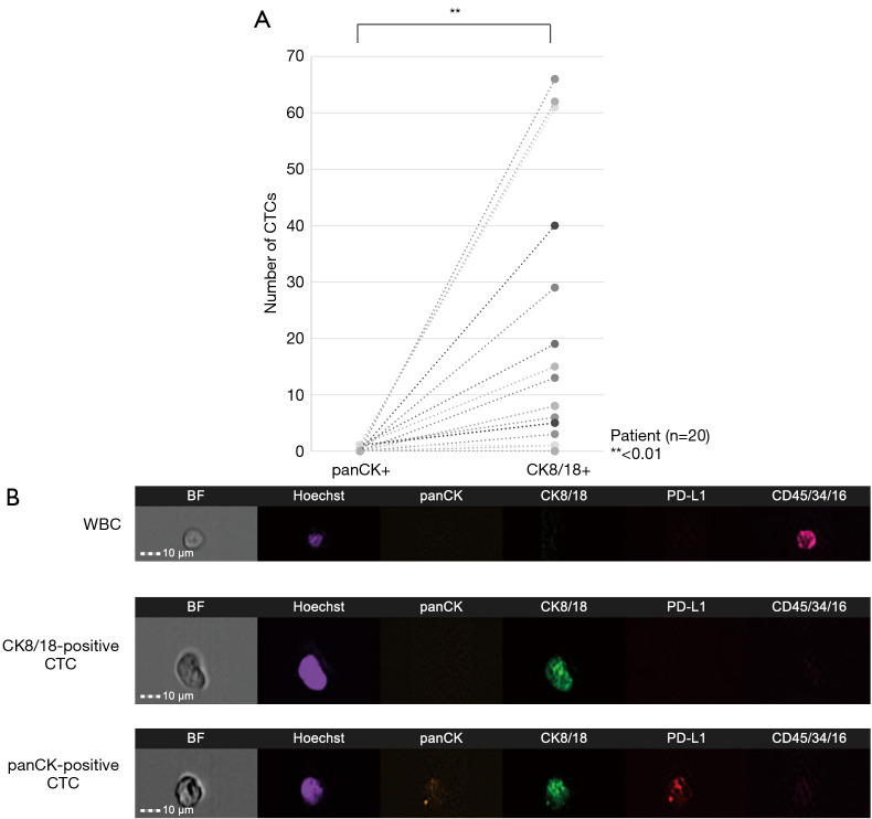 Utility of CK8/18 in identifying circulating tumor cells derived from lesions in patients with non-small cell lung cancer.