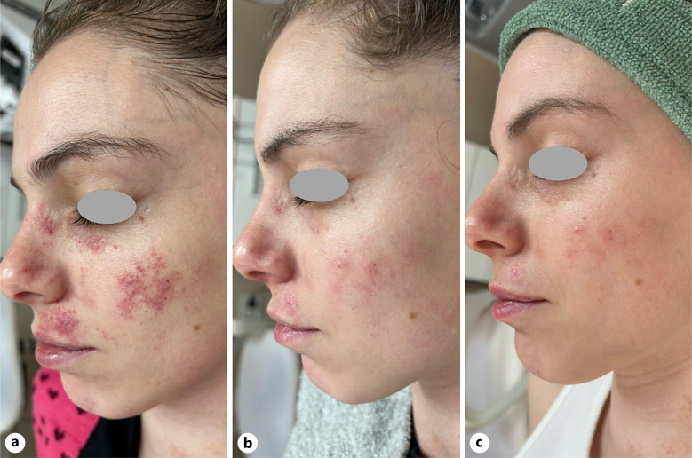 Efficacy of Sequential Combination of Long-Pulsed Potassium Titanyl Phosphate 532-nm and Quasi Long-Pulsed 1,064-nm Nd:YAG Laser Therapy for Port-Wine Stain Treatment: A Case Report.