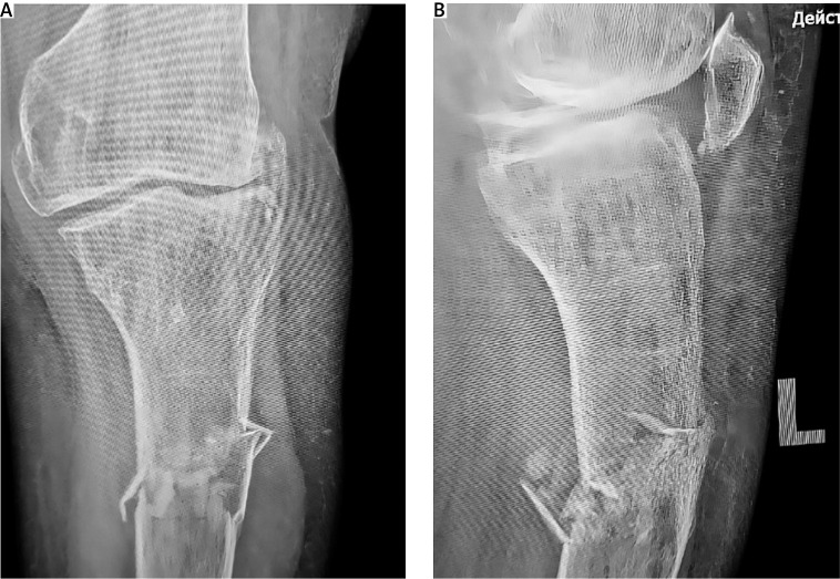 The use of regenerative technologies for treatment of delayed fracture union in patient with menopausal osteoporosis.