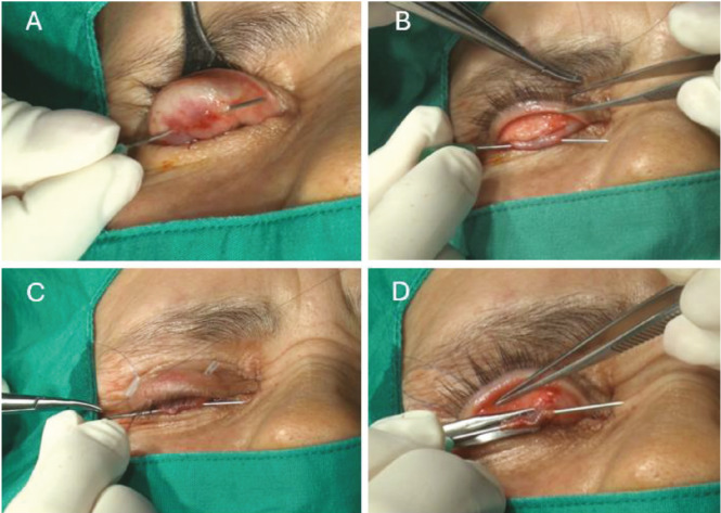 Ptosis Repair by "PEANUTS" MMCR: "Pelin's Easy and Needle Up To Stretch" Müller's Muscle Conjunctival Resection Without the Putterman Clamp.