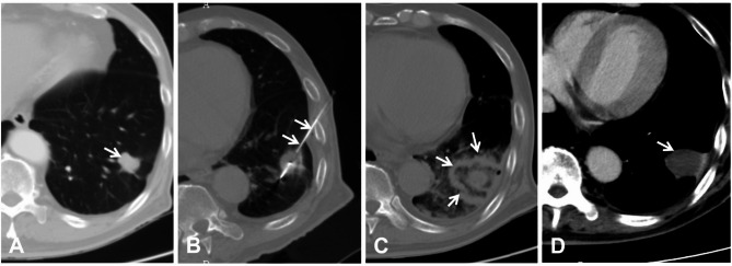 Thermal ablation for pulmonary oligometastases from hepatocellular carcinoma: initial experience and retrospective study.