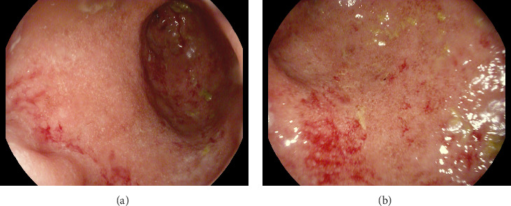 Development of Ulcerative Colitis in a Patient With Human Immunodeficiency Virus.