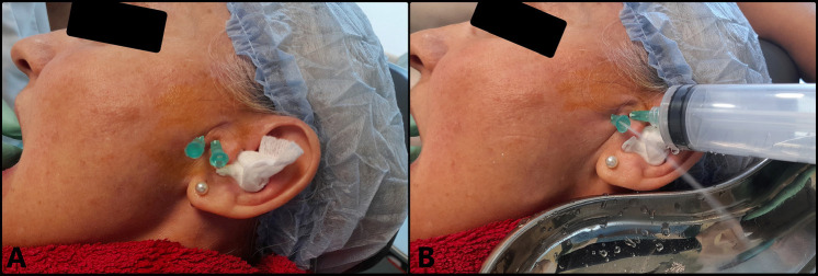 Importance of early arthrocentesis in temporomandibular joint closed lock by disc displacement without reduction. A case review.