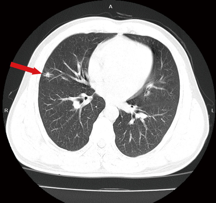Surgical treatment of IIIb (N2), ROS1(+) non-small cell lung cancer after neoadjuvant chemotherapy combined with targeted therapy: a case report.