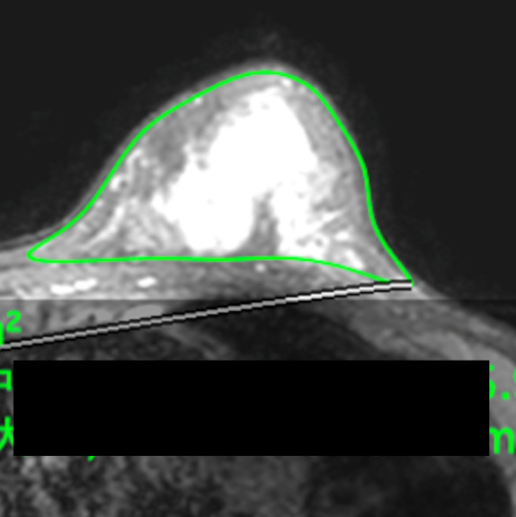 Use of Three-Dimensional Surface Imaging to Measure Breast Volume in the Upright Position With Acceptable Accuracy.