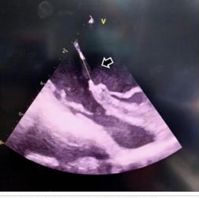 Surgical repair of partial atrioventricular septal defect (pAVSD) in adulthood: A rare case report.