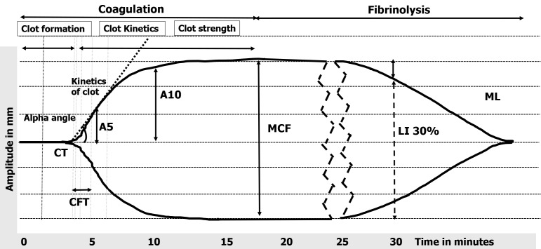 Redefining haemostasis: Role of rotational thromboelastometry in critical care settings.