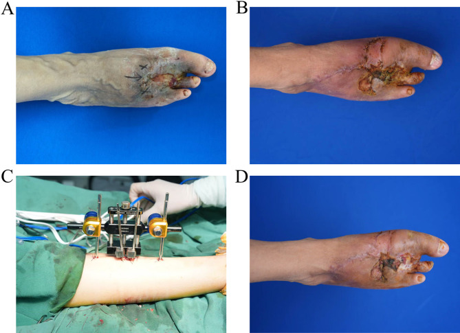 Ilizarov-assisted periosteal distraction for refractory arteriovenous malformation ulcers: first clinical report in Asia.